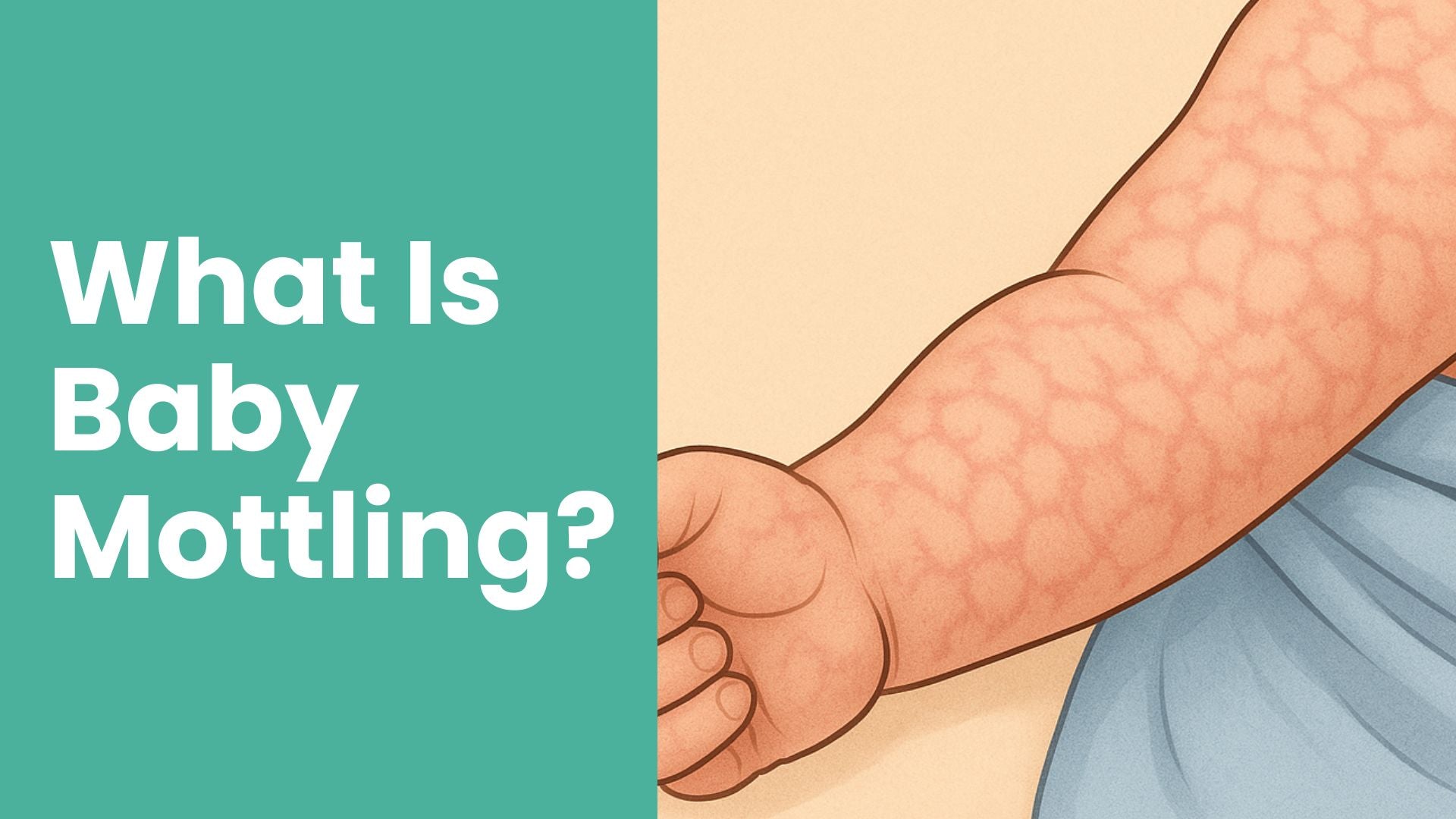 What Is Baby Mottling? Causes, Concerns, and When to Worry - Babysense